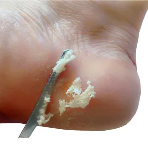 Professional Foot Scraper Stainless Steel Foot Care Pedicure Scraper Portable Nail Clipper Exfoliating Tool